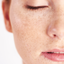  Imagen de una mujer con pecas en su rostro y piel seca.