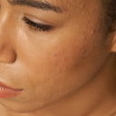 Piel con brotes, espinillas y granos